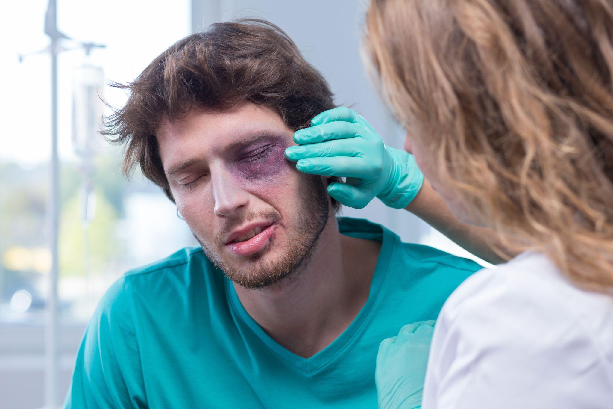 Maritime worker with black eye from work 