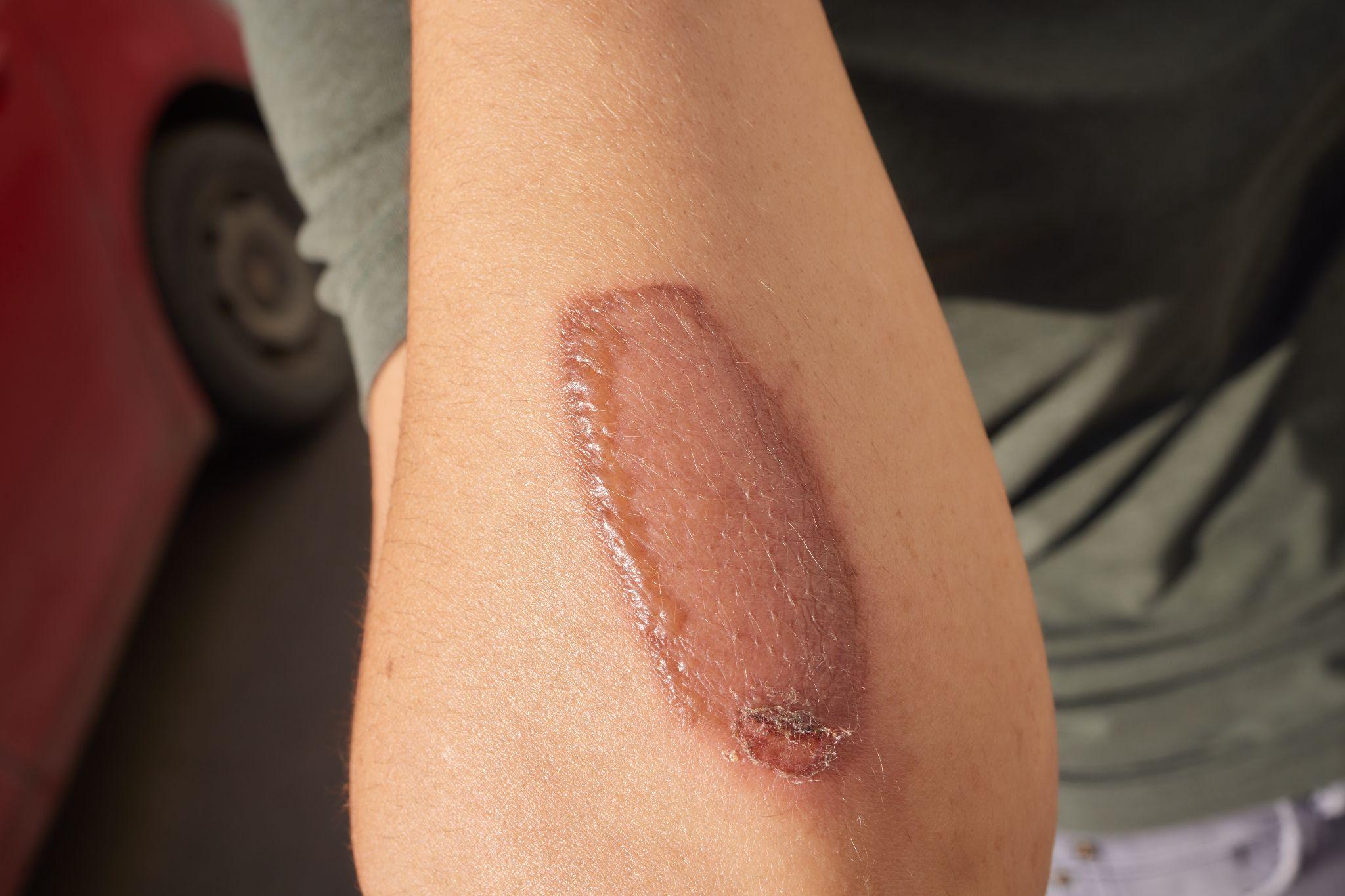 Chemical burn on arm